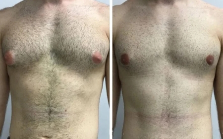 Step-by-Step Process of Getting Gynecomastia Surgery in Dubai