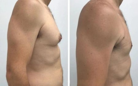 Best Gynecomastia Surgeons in dubai: Top Picks for Male Breast Reduction