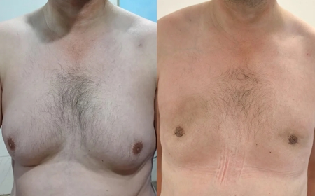 The Complete Guide to Gynecomastia Surgery in Islamabad for Men