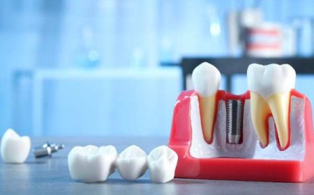 Bone Grafting Explained: The Foundation of Implant Reliability