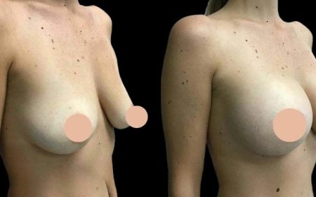 Breast Augmentation Surgery vs. Fat Transfer: What the Best Doctors in Dubai Recommend