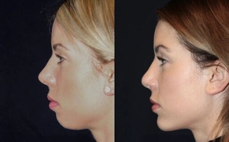 Best Aesthetic Clinics in dubai for Chin Fillers: Minimizing Pain and Discomfort