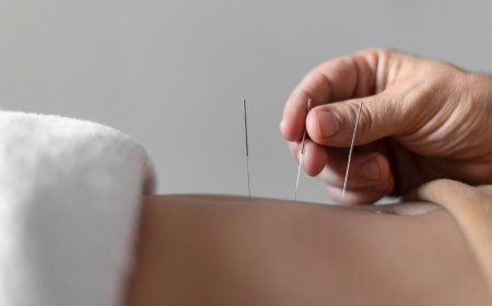 The Intersection of Dry Needling and Chinese Medicine: Unlocking New Paths to Healing