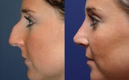 Beyond the Mirror: The Aesthetic and Functional Wonders of Rhinoplasty