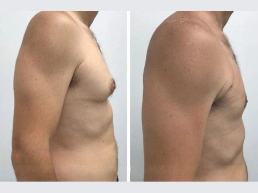 Best Gynecomastia Surgeons in dubai: Top Picks for Male Breast Reduction