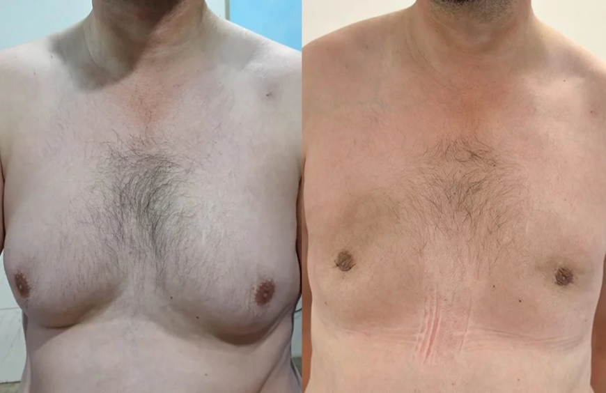 The Complete Guide to Gynecomastia Surgery in Islamabad for Men
