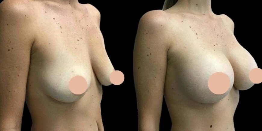 Breast Augmentation Surgery vs. Fat Transfer: What the Best Doctors in Dubai Recommend